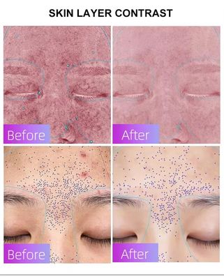 comprar Blue Light Acne Treatment Mask with Intelligent Timer – Manufacturer Direct Supply, Appearance Patent Included fabricação em linha